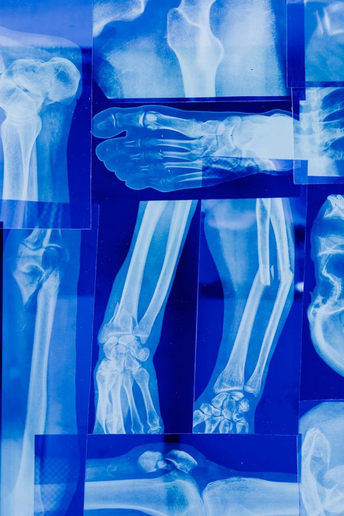 Various X-Ray Imaging of a Persons Bones